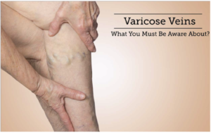 Best Varicose Veins Treatment in Ludhiana